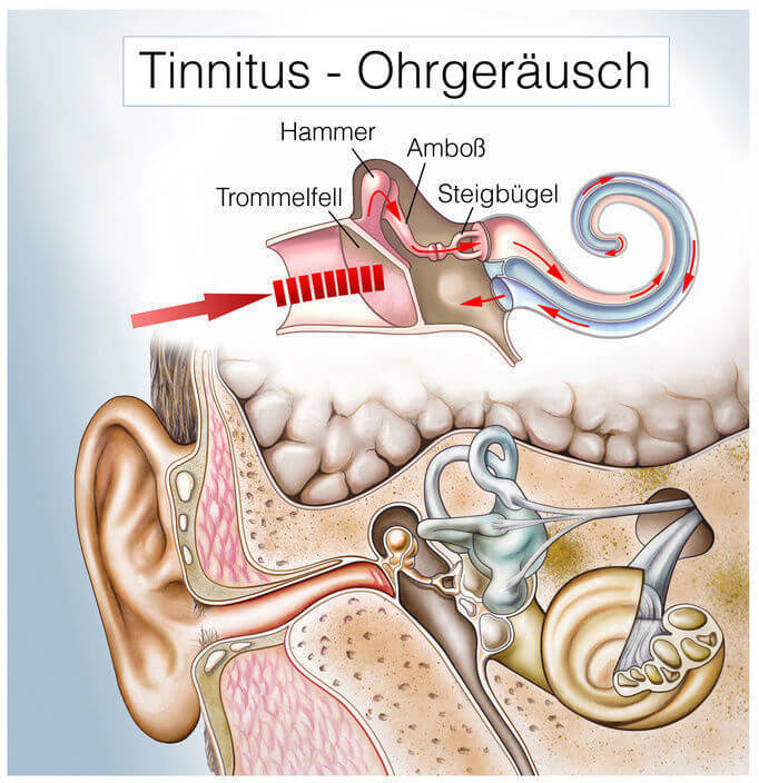 Tinnitus - Ohrgeräusch